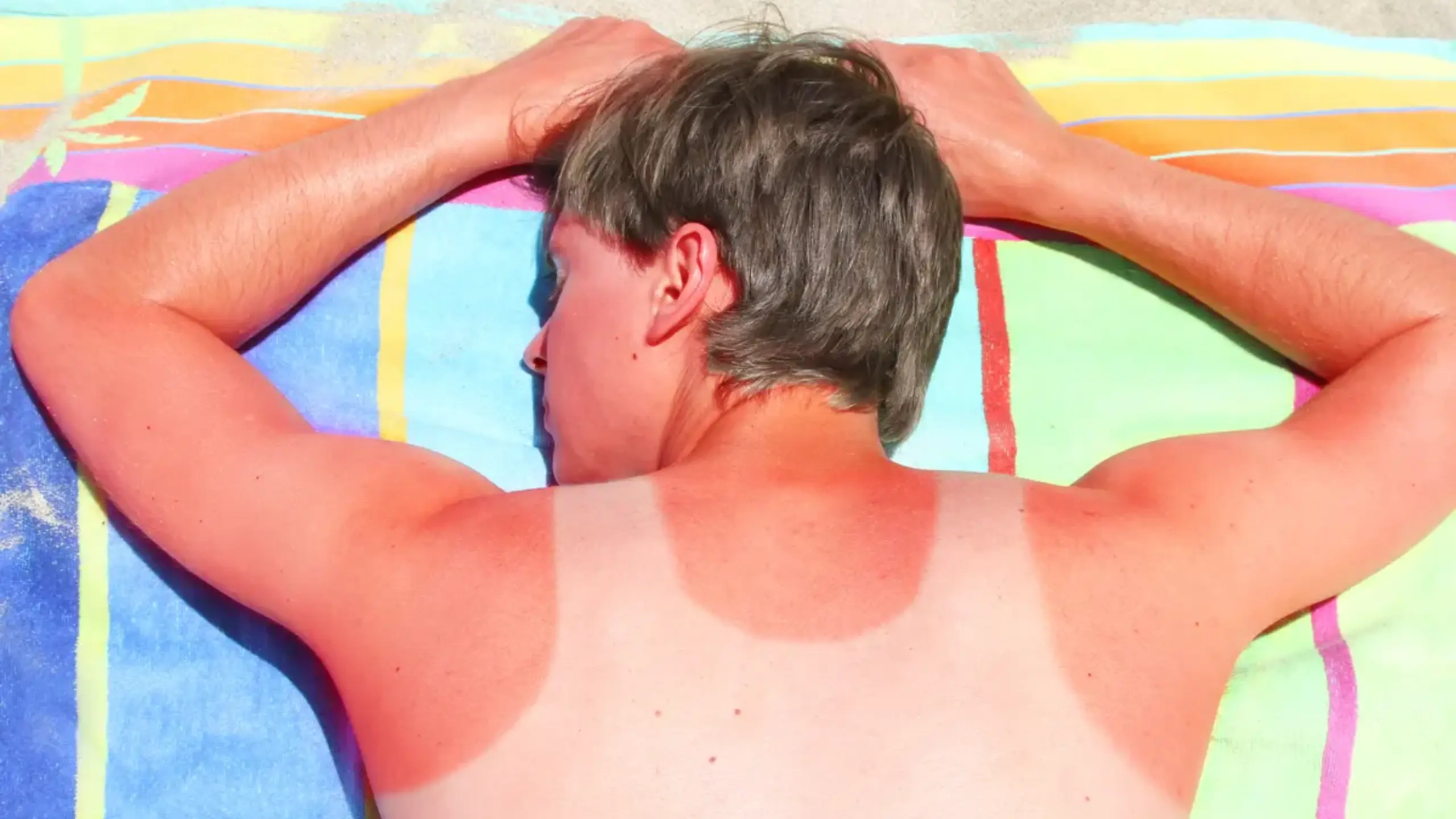 How to Stop a Sunburn from Itching